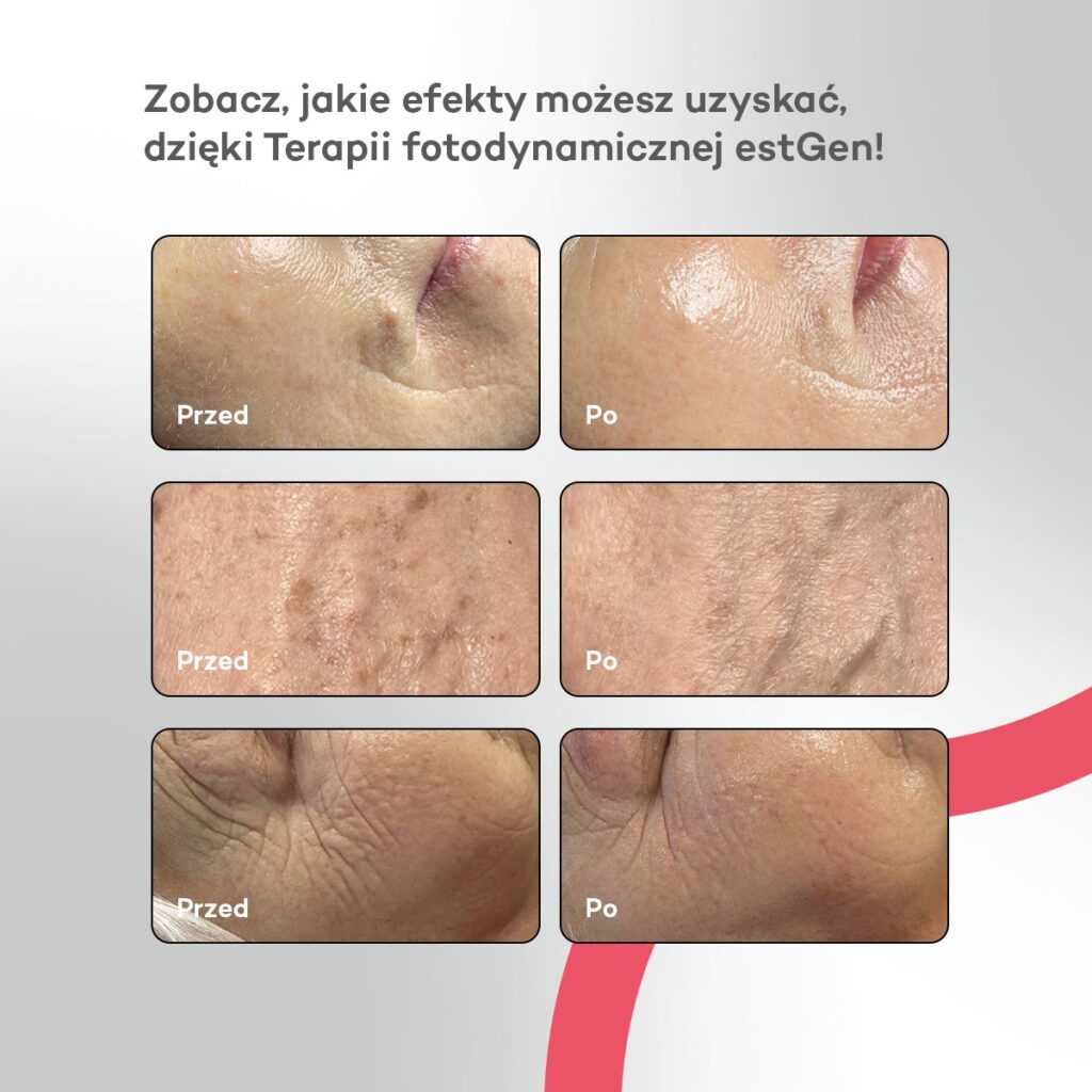 estgen fototerapia kielce